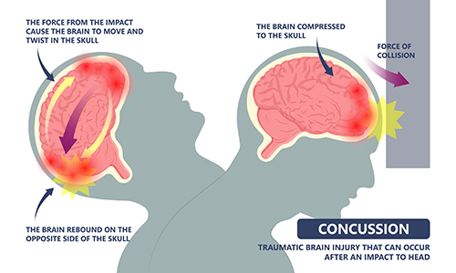 Concussions And Car Accidents