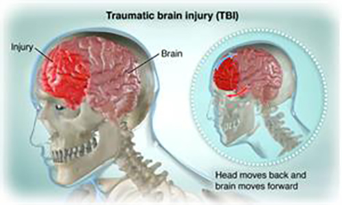 Post Concussion Syndrome